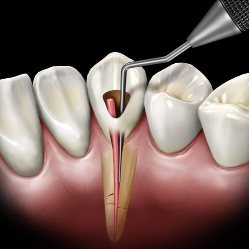 Endodonti