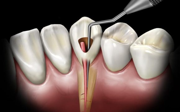 Endodonti