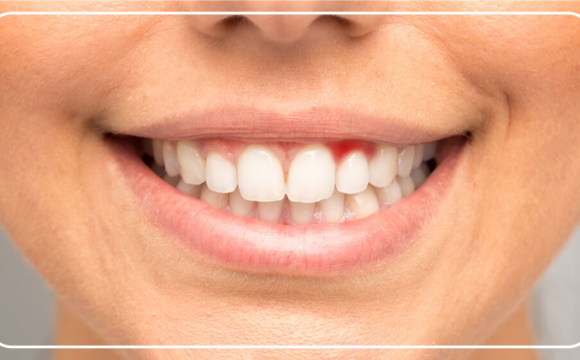 Diş Eti Tedavisi Bitkisel